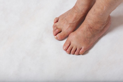 Understanding Hammertoe and Finding Relief