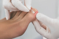 Relief Options for Ingrown Toenails