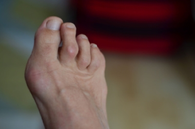 Understanding Hammertoe