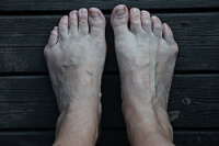 Causes and Treatment of Bunionettes