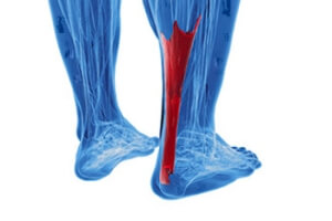 Exploring Achilles Tendonitis