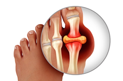 Recognizing the Signs and Seeking Relief From Gout