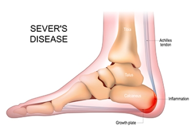 Sever's Disease and Growing Pains That Should Not Be Ignored