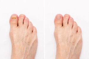 Definition and Risk Factors of Onychomycosis
