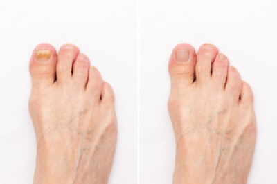 Definition and Risk Factors of Onychomycosis